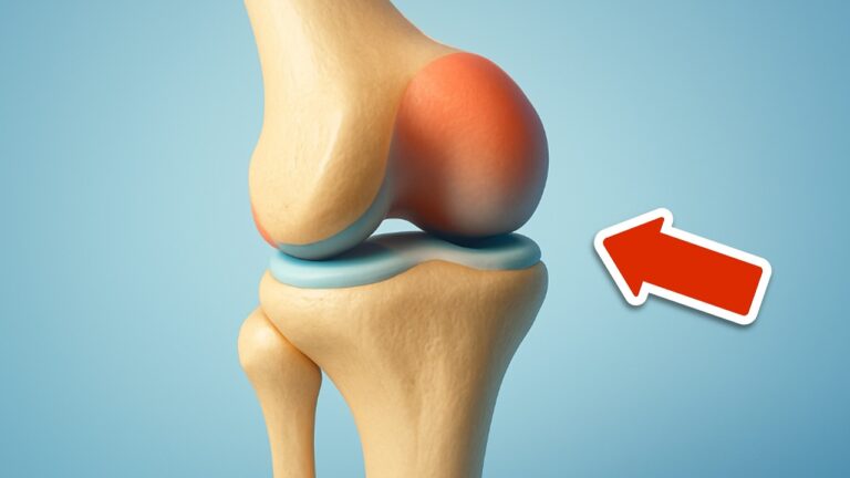 Discover the 1 Vitamin That Could Prevent Knee Surgery Everyone Overlooks!