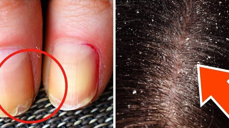 8 Warning Signs of Omega 3 Deficiency You Must Not Ignore!