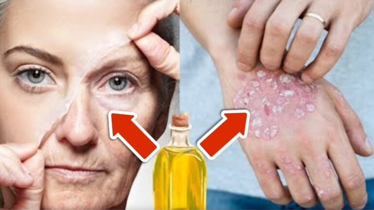 Eliminate Wrinkles & Psoriasis with Just 1 Drop of This Powerful Oil!
