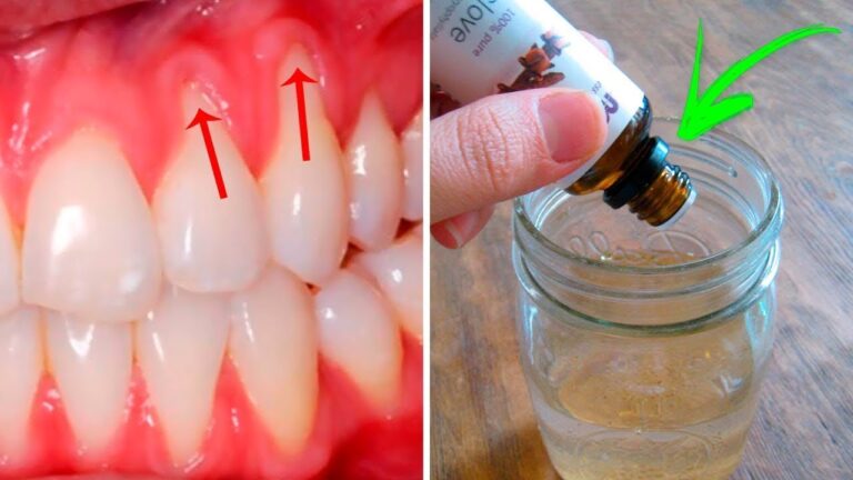 3 Simple Ways to Naturally Heal Receding Gums for a Healthier Smile