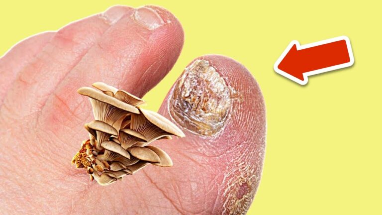 Get Rid of Fungal Infections Forever: 7 Home Remedies That Actually Work!