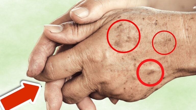 7 Foods That Erase Age Spots Overnight – Discover Their Secrets Now! 💥